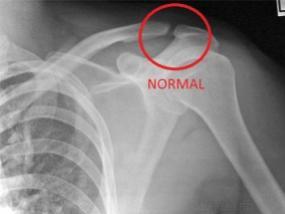 What to expect when you're not expecting, an acromioclavicular (AC ...